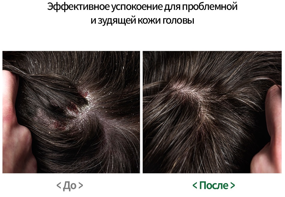 Yur_me_Miracle_Scalp_Pack_before_After.jpg